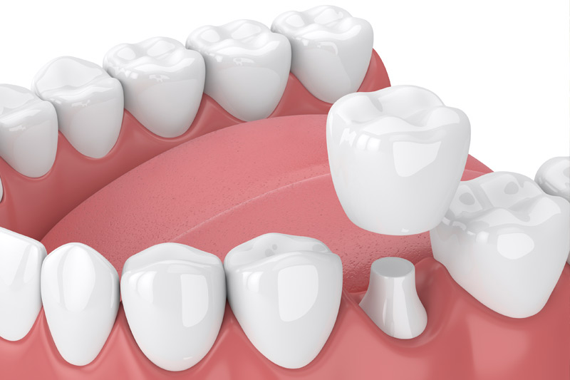 Dental Crowns in Aubrey